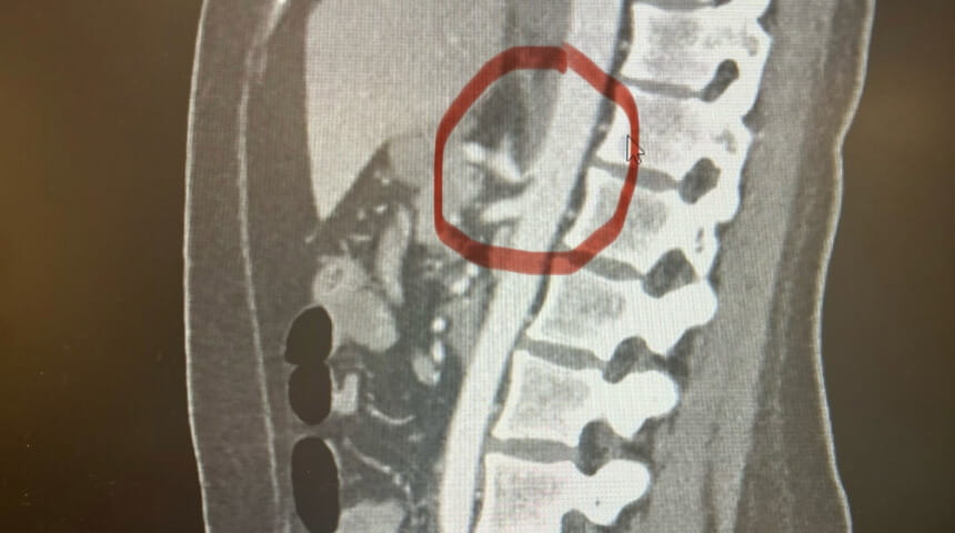 New Protocol Streamlines Diagnosis and Treatment of Rare Celiac Artery Compression Syndrome