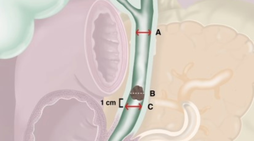 Innovative Protocol for Common Bile Duct Stone Clearance Published in Digestive Endoscopy