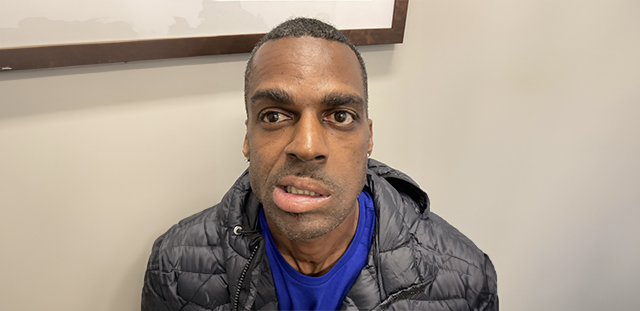 Man before Facial Reanimation