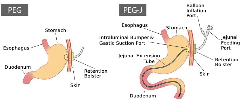 Feeding Tubes for Nutritional Support