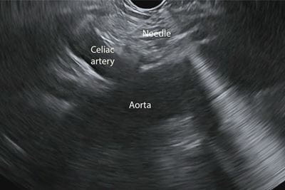 Chronic Pancreatitis