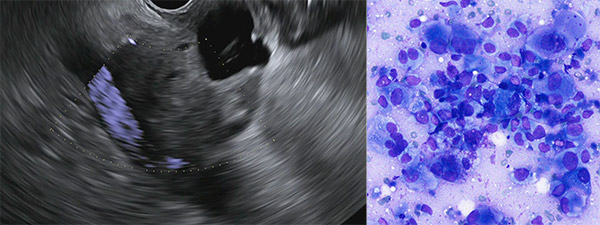 Chronic Pancreatitis