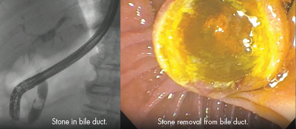 Endoscopic Retrograde Cholangiopancreatography