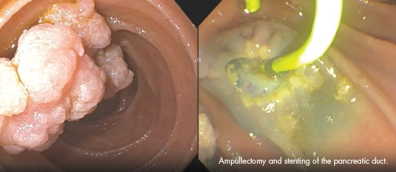 Ampullectomy