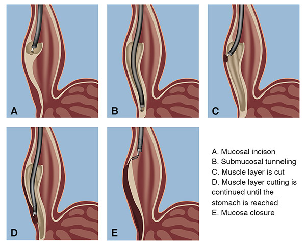 Chronic Pancreatitis