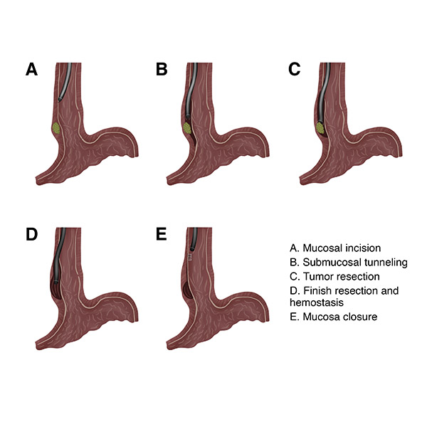 Chronic Pancreatitis