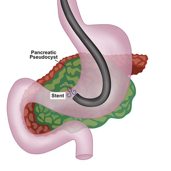 Chronic Pancreatitis