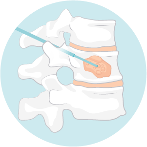 One or two probes are inserted through small (1cm) incisions.