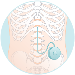 The pump is implanted just below the skin of the abdomen, allowing targeted pain relief in smaller doses with fewer side effects.