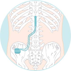 Spinal Cord Stimulator