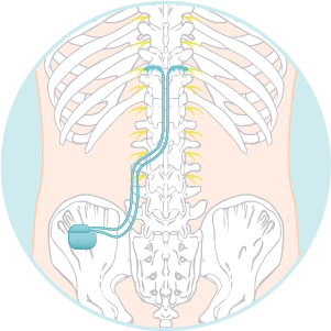 Dorsal Root Ganglion Stimulator