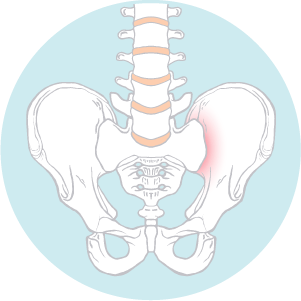 Patient is experiencing severe pain in the lower back and buttocks due to an injured sacroiliac joint.