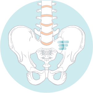 Channels are created and titanium implants are inserted to stabilize the sacroiliac joint, stopping the pain.