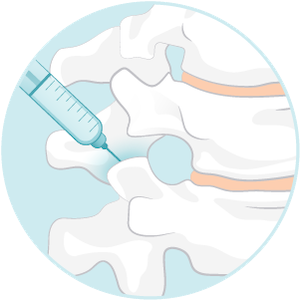 Anesthetic and steroid injection into the inflamed facet joint.