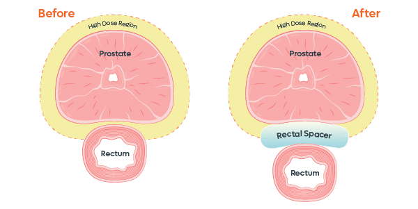 Before and After Rectal Spacer