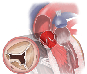 Aortic-insufficency-chart-2-400x615