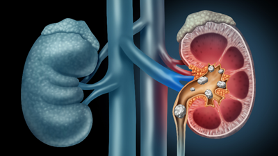 Image of kidney stones.
